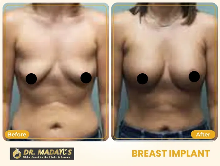 Breast implant before and after result 2 at Dr Madan Aesthetics